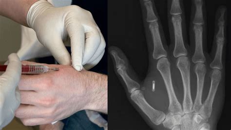 inserting rfid chip|rfid implants for dogs.